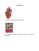 Referāts 'Hipertrofiskā kardiomiopātija', 17.