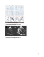 Referāts 'Hipertrofiskā kardiomiopātija', 20.