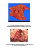 Prezentācija 'Kuņģa karcinoma', 12.