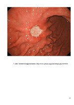 Prezentācija 'Kuņģa karcinoma', 13.