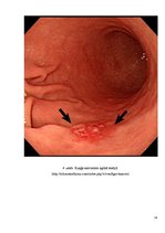 Prezentācija 'Kuņģa karcinoma', 14.