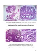 Prezentācija 'Kuņģa karcinoma', 17.