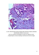 Prezentācija 'Kuņģa karcinoma', 18.