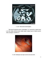 Prezentācija 'Kuņģa karcinoma', 21.