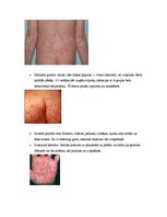 Konspekts 'Psoriāzes patoģenēze, klīniskās izpausmes un ārstēšana', 3.