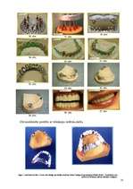 Referāts 'Kombinētās protēzes ar teleskopu sistēmu izgatavošanas tehnoloģija', 10.