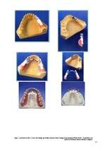 Referāts 'Kombinētās protēzes ar teleskopu sistēmu izgatavošanas tehnoloģija', 11.