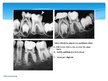 Prezentācija 'Endodontija bērniem - pastāvīgajiem zobiem ar nenoformētām saknēm', 12.