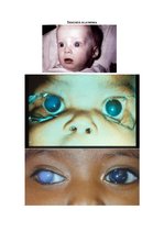 Referāts 'Iedzimtā glaukoma', 5.