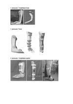 Referāts 'Ortozēšanas iespējas apakšstilba kaulu osteomielīta izraisīto ortopēdisko traucē', 35.