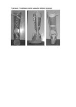 Referāts 'Ortozēšanas iespējas apakšstilba kaulu osteomielīta izraisīto ortopēdisko traucē', 36.