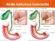 Prezentācija 'Akūts holecistīts', 6.