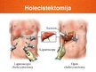 Prezentācija 'Akūts holecistīts', 30.