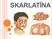 Prezentācija 'Skarlatīna', 1.
