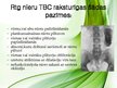 Prezentācija 'Nieru tuberkuloze', 9.