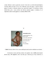 Referāts 'Hromosomālie sindromi, to raksturojums', 10.