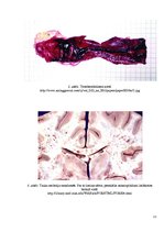 Konspekts 'Embolija', 11.