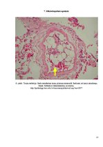 Konspekts 'Embolija', 13.