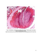 Konspekts 'Embolija', 14.