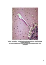 Konspekts 'Embolija', 15.