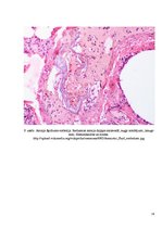 Konspekts 'Embolija', 16.