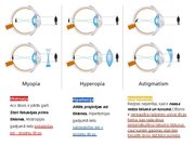 Prezentācija 'Redze. Acs uzbūve. Acu slimības', 32.