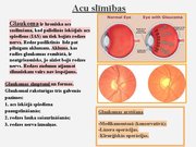 Prezentācija 'Redze. Acs uzbūve. Acu slimības', 36.