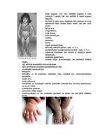 Konspekts 'Hromosomu aberācijas, monogēnās un multifaktoriālās slimības', 19.