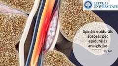 Prezentācija 'Spināls epidurāls abscess pēc epidurālas analgēzijas', 1.