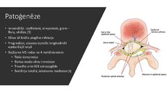Prezentācija 'Spināls epidurāls abscess pēc epidurālas analgēzijas', 4.