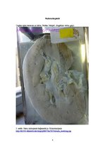 Konspekts 'Nieru hidropiskā deģenerācija', 8.