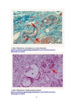 Konspekts 'Nieru hidropiskā deģenerācija', 11.