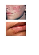 Konspekts 'Parastais herpess', 8.