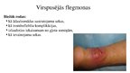 Prezentācija 'Flegmona', 10.