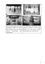 Diplomdarbs 'Periodonta slimību diagnostika un ārstēšanas metodes', 33.