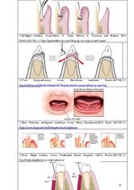 Diplomdarbs 'Periodonta slimību diagnostika un ārstēšanas metodes', 37.