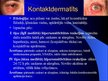 Prezentācija 'Plakstiņu patoloģijas', 4.
