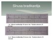 Prezentācija 'Lēkmjveidīgi sirds ritma traucējumi. Bradiaritmijas', 8.