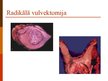 Prezentācija 'Vulvas vēzis', 18.
