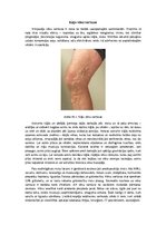 Eseja 'Kāju vēnu varikoze', 1.