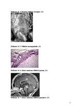 Konspekts 'Neirosifiliss', 11.