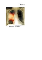 Konspekts 'Aprūpes plāns. Kreisās puses lobārā pneimonija', 46.