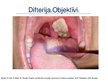 Prezentācija 'Angīnu diferenciāldiagnostika: angīna/difterija', 21.