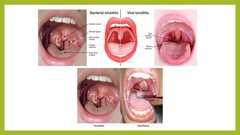 Prezentācija 'Angīnu diferenciāldiagnostika', 4.