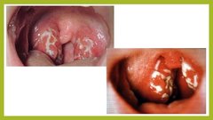 Prezentācija 'Angīnu diferenciāldiagnostika', 8.