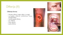 Prezentācija 'Angīnu diferenciāldiagnostika', 15.