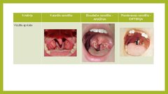 Prezentācija 'Angīnu diferenciāldiagnostika', 22.