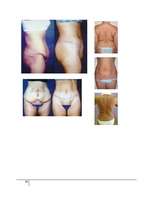 Referāts 'Abdominoplastika - vēdera priekšējās sieniņas plastika', 30.