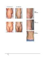 Referāts 'Abdominoplastika - vēdera priekšējās sieniņas plastika', 31.