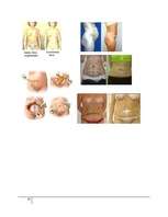 Referāts 'Abdominoplastika - vēdera priekšējās sieniņas plastika', 32.